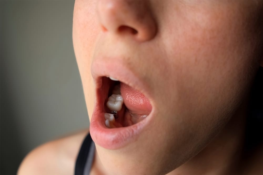 Woman patient opens mouth shows dental implant after healing in dentistry. Metal titanium implant in stomatology. Woman demonstrating implant after surgery. Prosthetic oral procedure.